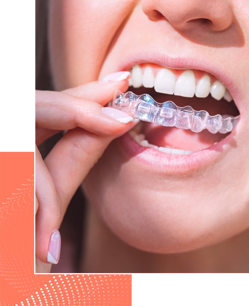 Aligneurs orthodontie_Cabinet du Centre